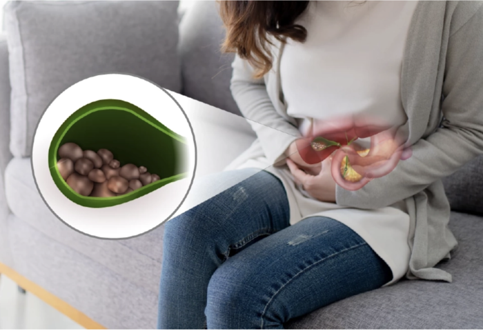 烤肉當心膽囊石　高脂飲食潛藏風險