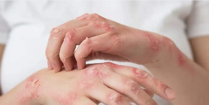 猴痘累計約千例　曼谷確診數居全泰之冠