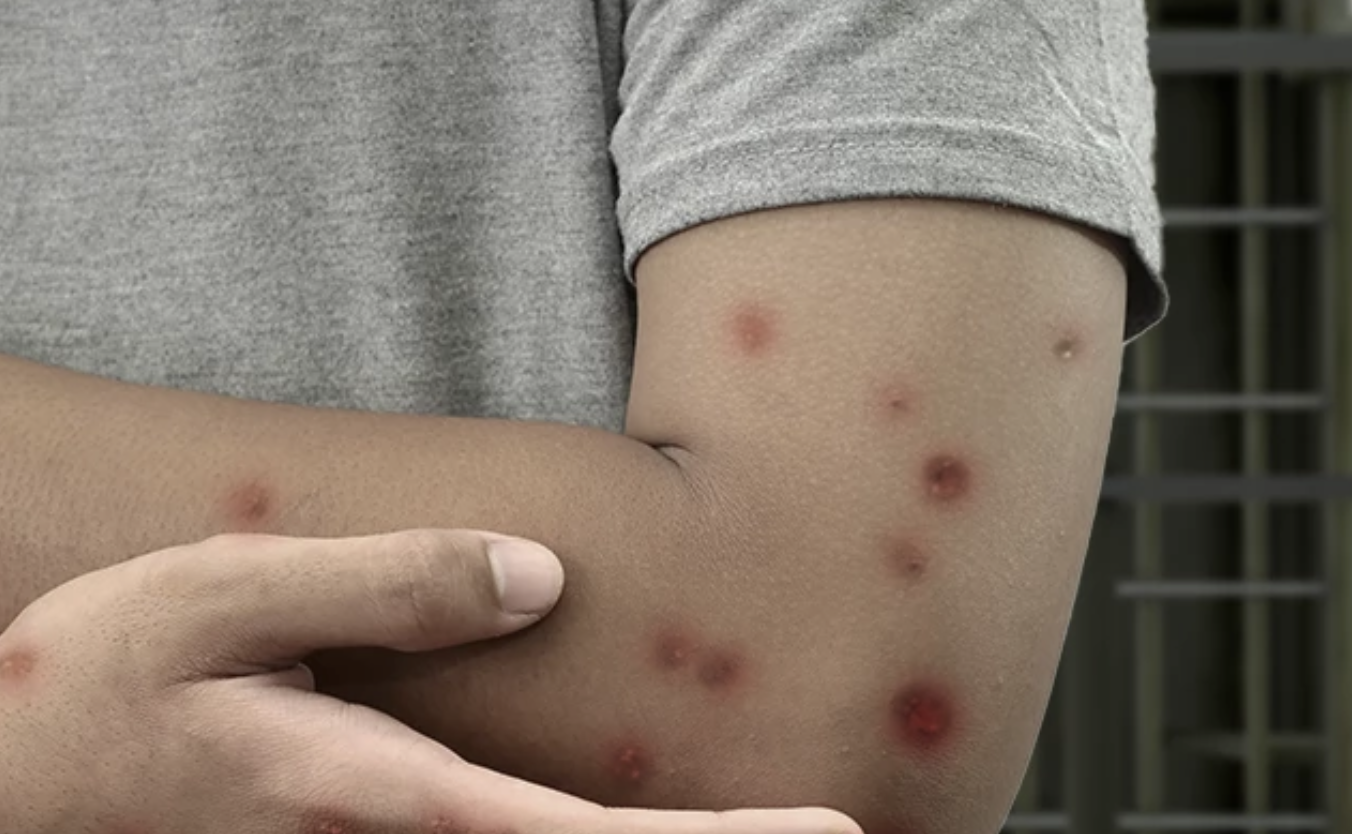 獄中新收容人染猴痘　當局啟動隔離防疫