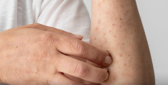 猴痘感染須頻接觸　醫學署列五風險群