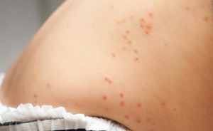 泰國水痘病例破萬　學齡兒童最多