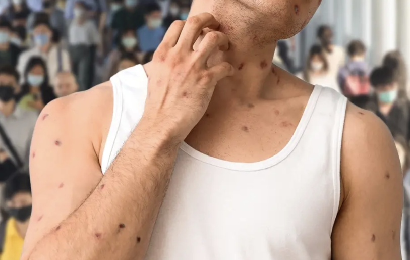 水痘疫情升溫　泰國3個月累計逾1.3萬例